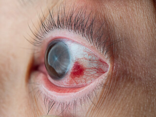 Red eyes with blood vessels in the eyes.