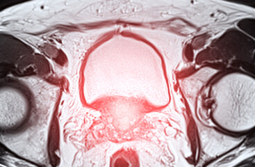 MRI of the prostate gland, revealing an enlarged size.