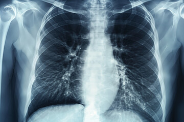 A close up of a person's chest with a blue hue. The image is of a person's chest and lungs, and it is a medical image. The blue color gives the image a calm and soothing mood