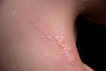 Fototapeta premium Rash caused by insect bites on skin shoulder,Itchy rash caused by water allergy,Rash caused by an allergic reaction urticaria,skin disease, skin symptoms, concept of medical and skin, closeup photo.