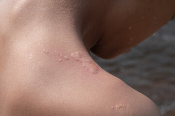 Rash caused by an allergic reaction urticaria,Rash caused by insect bites on skin shoulder,Itchy rash caused by water allergy,skin disease, skin symptoms, concept of medical and skin, closeup photo.