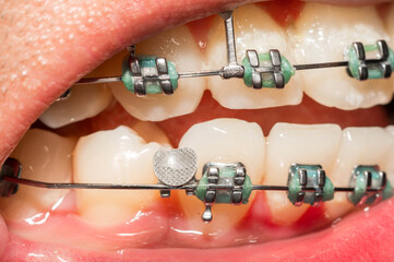 broken braces or wire breaks missing