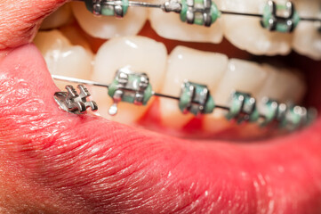 broken braces or wire breaks missing