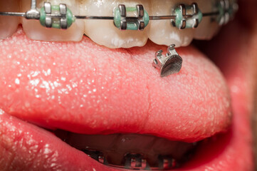 broken braces or wire breaks missing