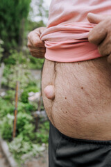 An adult man shows a large umbilical hernia on his stomach. Photography, illness.