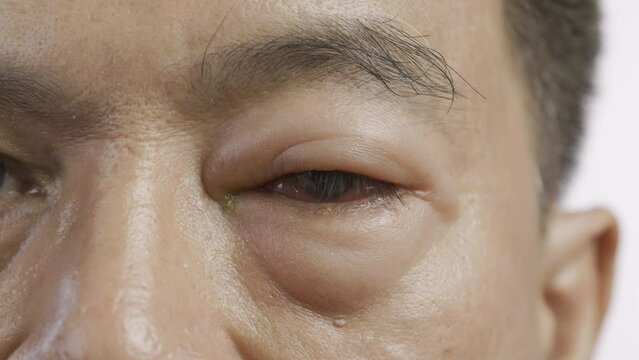 Senior man with swollen eye from insect bite on white background.