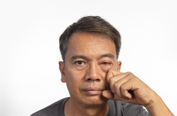 Senior man with swollen eye from insect bite on white background.