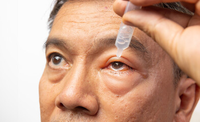 Senior man use artificial tears to treat swollen eye from insect bite.