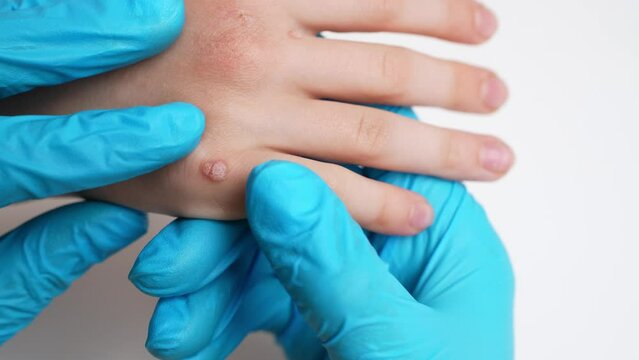 Dermatologist looks at child hand with viral flat warts, Verruca vulgaris, cure and treatment, close-up. Papillomavirus, HPV. Children dermatology, problems of skin diseases, one day surgery concept. 