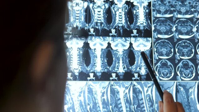 Female doctor reading X-ray scans moves pen over MRI images. Back view.