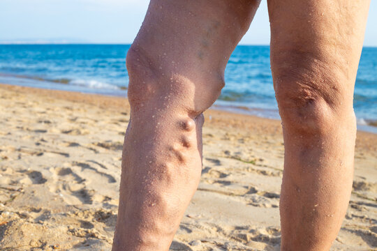 Sick female legs with thrombophlebitis and bumps, against the backdrop of the sea. Sanatorium and resort treatment for pensioners.