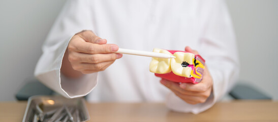 Dentist with tooth Anatomy model. Oral Teeth decay and disease, Scrape off tartar. March Oral...