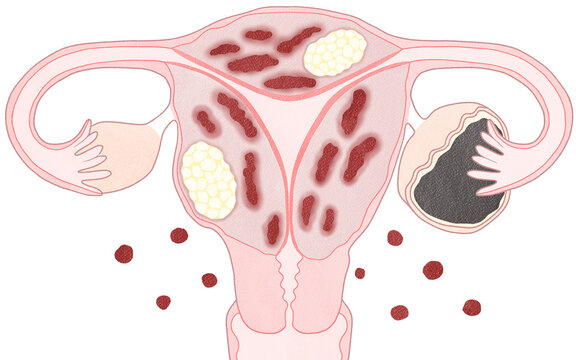 Blank uterine fibroids, Endometriosis and Adenomyosis; Unlabeled diagram transparent PNG