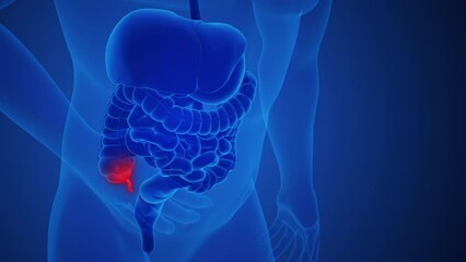 Appendix inflammation pain anatomy for medical concept