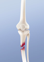 Close-up image of broken leg bone. Realistic vector illustration.
