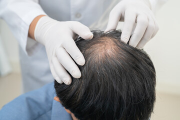 Fototapeta premium Doctor checkup and treatment Asian man baldness hair problem patient.