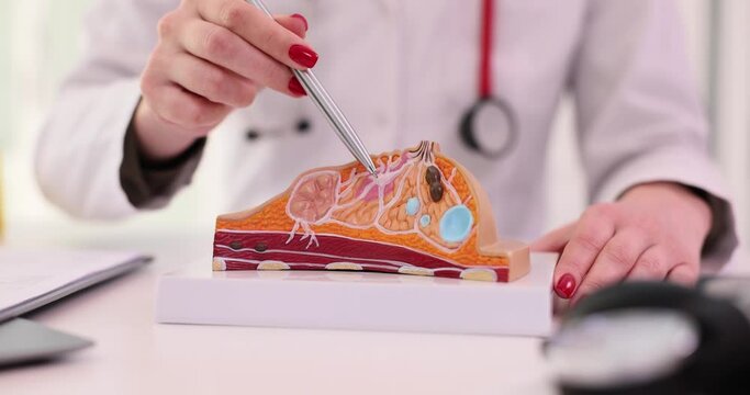 Female doctor explains the disease using an anatomical model of breast. Diagnosis of mammological diseases