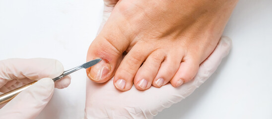 Pedicure, podologist. Patient on medical pedicure procedure, nail disease, cholesis detachment of...