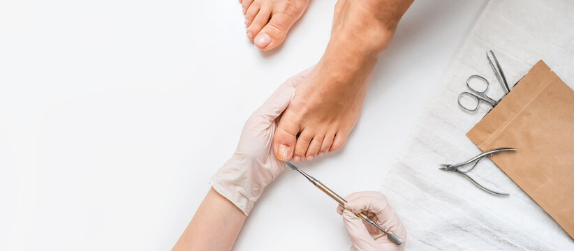 Pedicure, podologist. Patient on medical pedicure procedure, nail disease, cholesis detachment of the nail plate. Foot care, treatment in a medical spa salon.