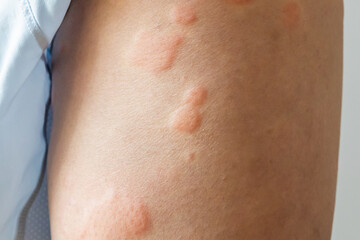 Young asian man has allergic skin rash on his legs from itchy dry skin eczema dermatitis insect...