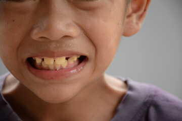 Asian young boy smiling and showing yellow teeth or dental fluorosis and gapped teeth or diastema concept of medical and dentistry for oral health care.
