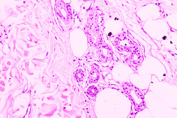 Naklejka premium Backgrounds of human cells tissue of cervix under the microscope in pathology lab.View in microscopic of ductal cell carcinoma, adenonocarcinoma from human breast cancer, tissue section by H and E