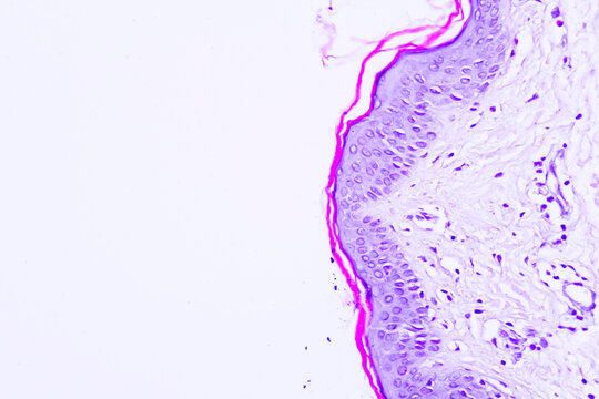 Backgrounds of human cells tissue of cervix under the microscope in pathology lab.View in microscopic of ductal cell carcinoma, adenonocarcinoma from human breast cancer, tissue section by H and E