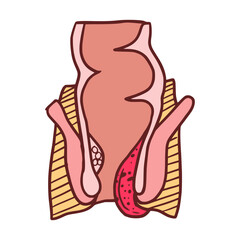 hemorrhoids internal stage 4 vector illustration