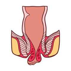 hemorrhoids external stage 4 vector illustration