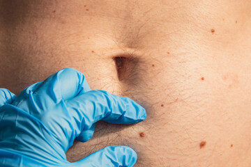 Doctor in medical gloves examining man skin mole. Dermatologist checking male birthmarks. Self care...
