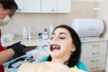  The process of installing.Dentistry, Smile design, White teeth.Restoration of teeth.