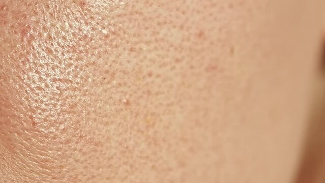 Unhealthy oily facial skin with enlarged pores and shiny sebum, texture part of the face.	