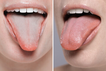 Obraz premium Woman showing her tongue before and after cleaning procedure, closeup. Tongue coated with plaque on one side and healthy on other, collage