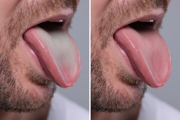 Man showing his tongue before and after cleaning procedure, closeup. Tongue coated with plaque on...