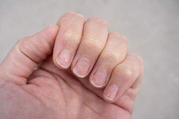 Regrown nail cuticle and damaged nail plate after gel polish. Flaky brittle nails without a...