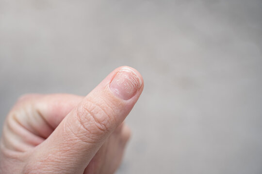 Regrown nail cuticle and damaged nail plate after gel polish. Flaky brittle nails without a manicure.