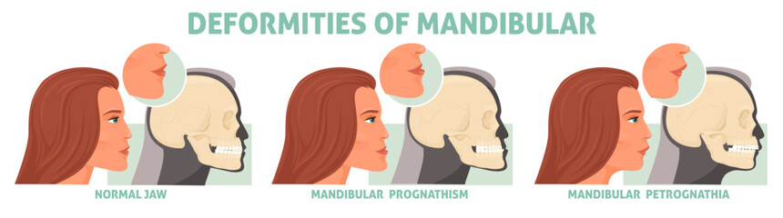 Female jaw deformities of mandibular medical poster vector illustration. Woman with normal face and abnormality. Dental defects reconstructive treatment advertisement © Siberian Art