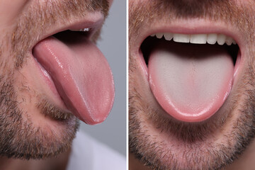 Man showing his tongue before and after cleaning procedure, closeup. Tongue coated with plaque on...