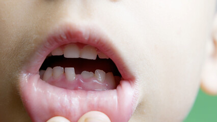 Close up, boy opens his mouth and shows his milky teeth. One missing tooth replaced with permanent...