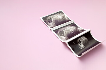 Ultrasound Image, Picture Of 7 Weeks Pregnant Woman With Twins, Embryo On Pink Background. Selective Focus. Space For Text, Mockup. Fetus Development, Pregnancy Health Checking. Maternity, Horizontal