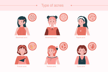 Types of Acne in Women Skin