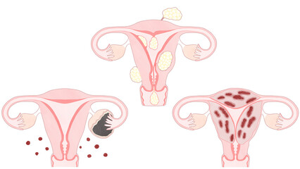 Blank Uterine fibroids, Endometriosis and Adenomyosis; Unlabeled diagram transparent PNG
