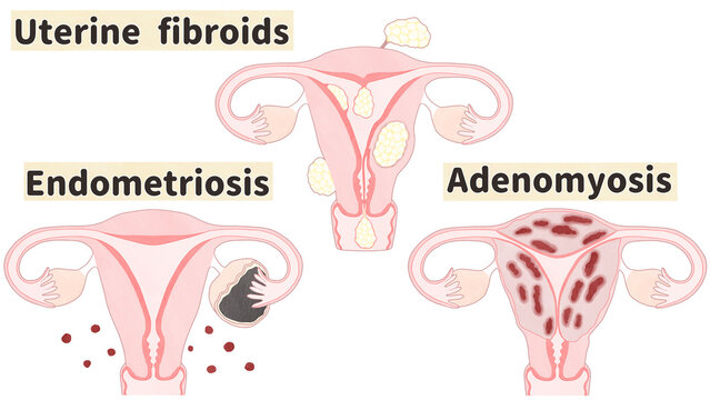 Uterine fibroids, Endometriosis and Adenomyosis; Labeled diagram PNG