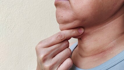 Close up the fingers holding the flabbiness adipose sagging skin under the chin, neck wattle and...