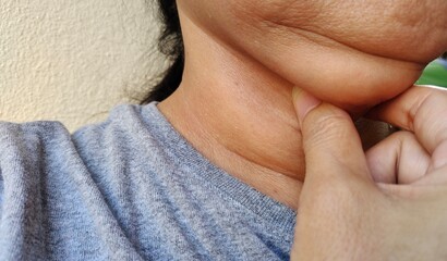 close up the fingers holding the flabbiness adipose sagging skin under the chin, neck wattle and...