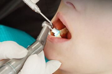 Dentist assistant with patient by prophylaxis polish teeth with polishing paste, a dental...