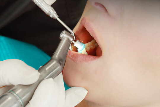 Dentist assistant with patient by prophylaxis polish teeth with polishing paste, a dental application or prevention. 