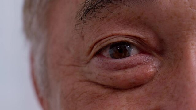 Close up of the senile cataract during eye examination. A white cloudy disc is seen in black eye circle, mature cataract, nuclear sclerosis cataract. Close up half face view