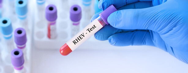 Doctor holding a test blood sample tube with Rocahepevirus, ratti, (RHEV) virus test on the...