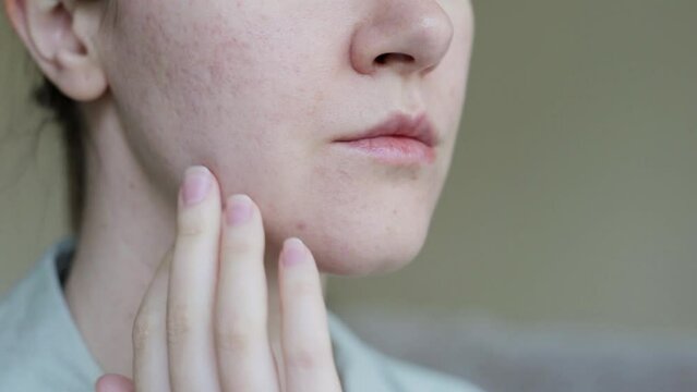 Woman's face in profile with problem skin pigment spots scars scars post acne